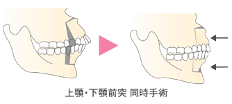 上顎前突（出っ歯）の手術法　上顎・下顎前突　同時手術